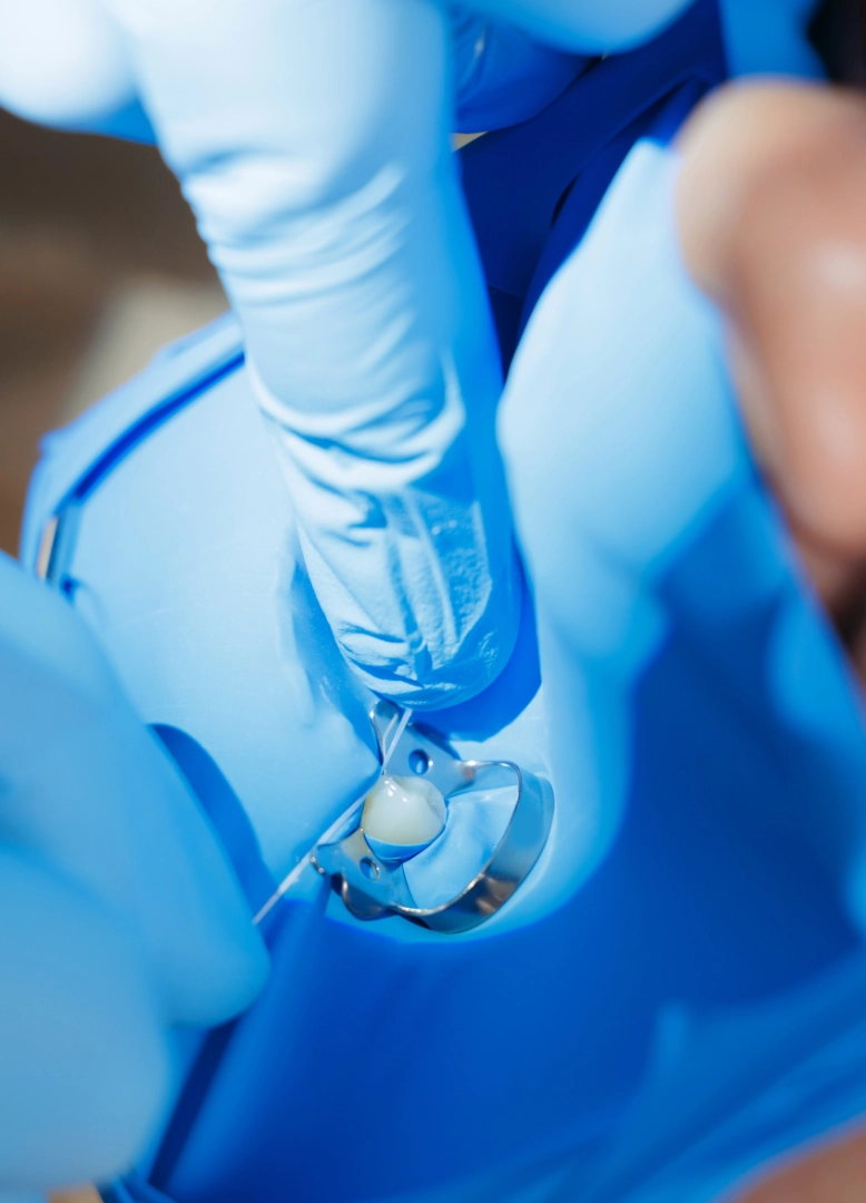 devitalizzazione-denti-e-cura-infezioni-monza-brianza