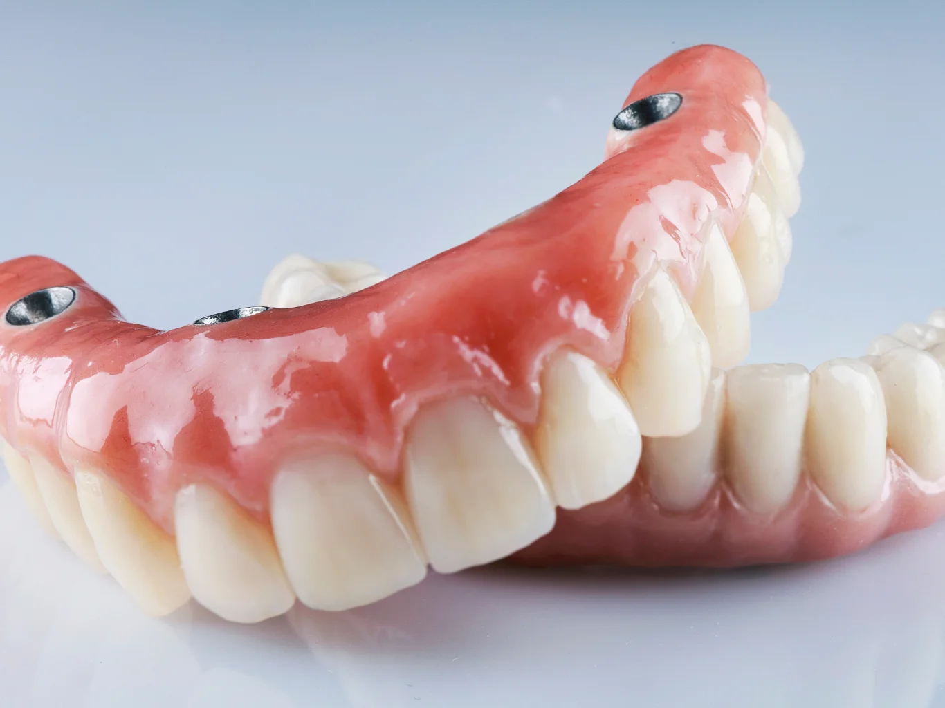 impLantologia-dentale-sostituzione-denti-seregno