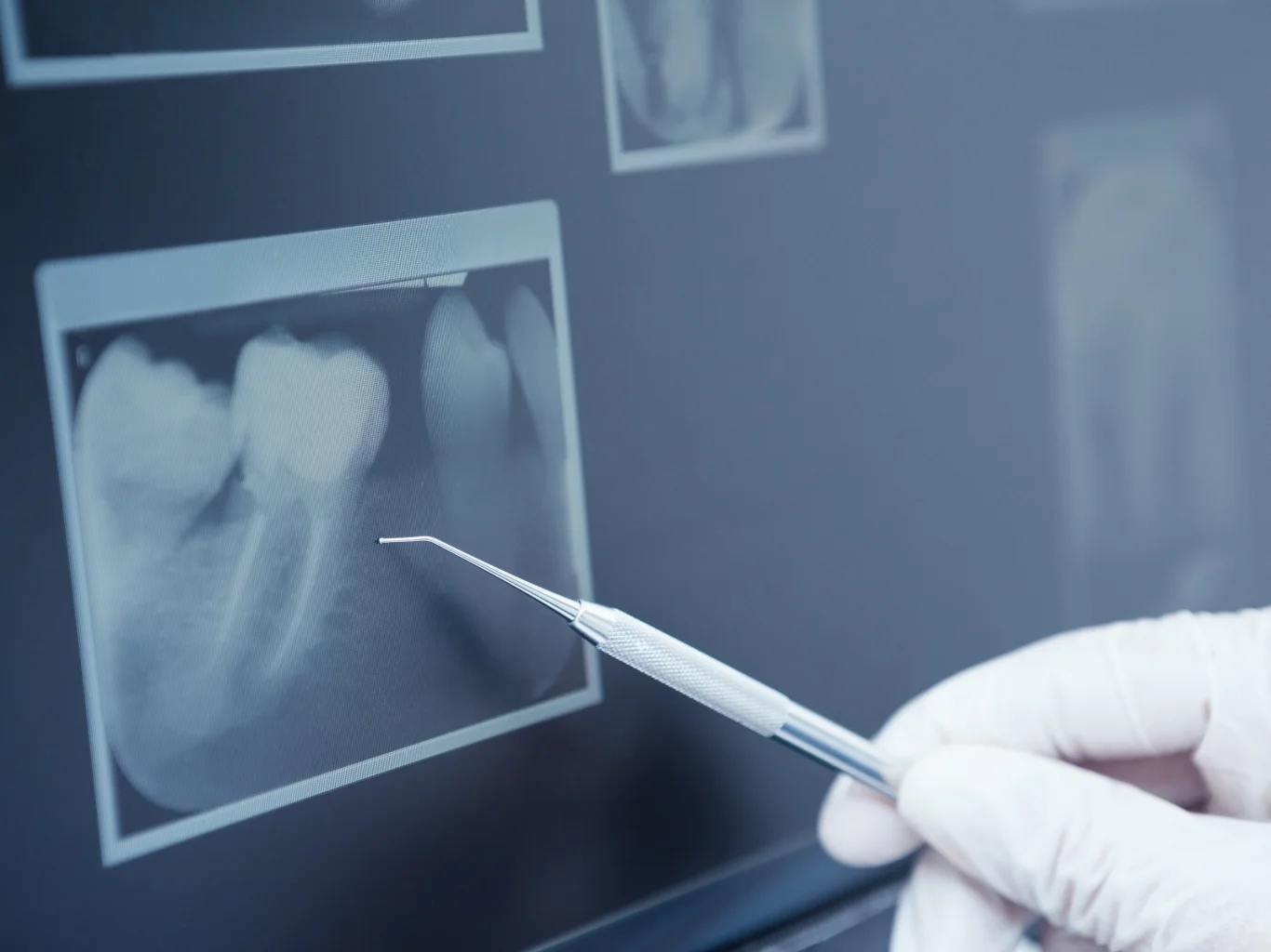 otturazioni-odontoiatra-cura-seregno