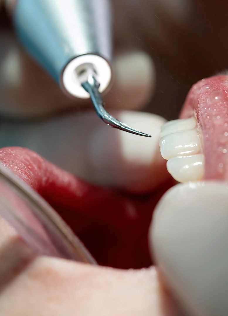 prevenzione-e-igiene-dentale-monza-brianza