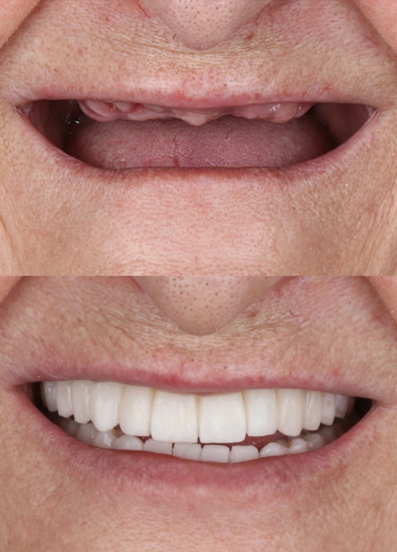 prima-e-dopo-dentiera